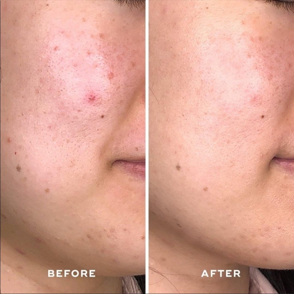 Aceology Detoxifying Treatment Mask - Picture 6 of 7